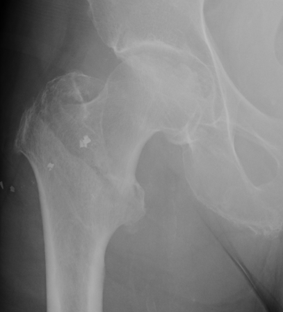 Hip Intertrochanteric Fracture Type 3